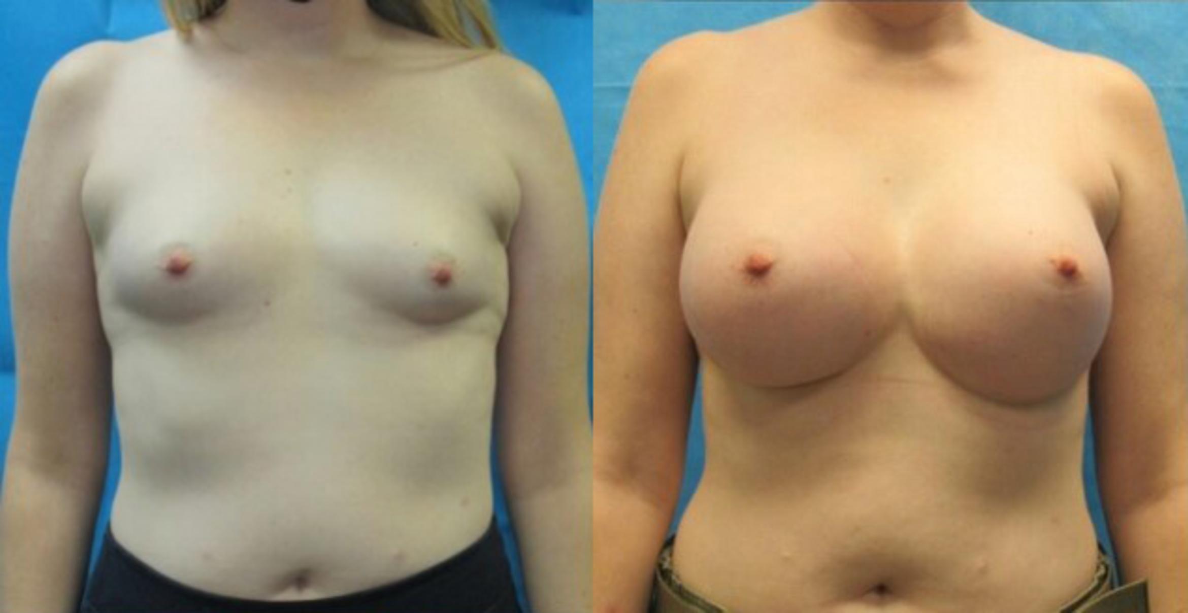 Before & After Breast Augmentation Case 1 View 1 View in Savannah, GA