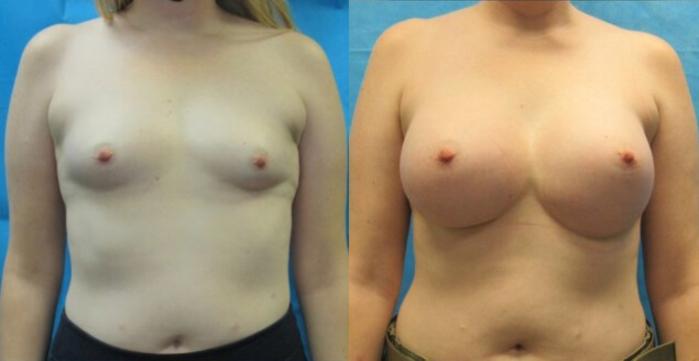 Before & After Breast Augmentation Case 1 View 1 View in Savannah, GA