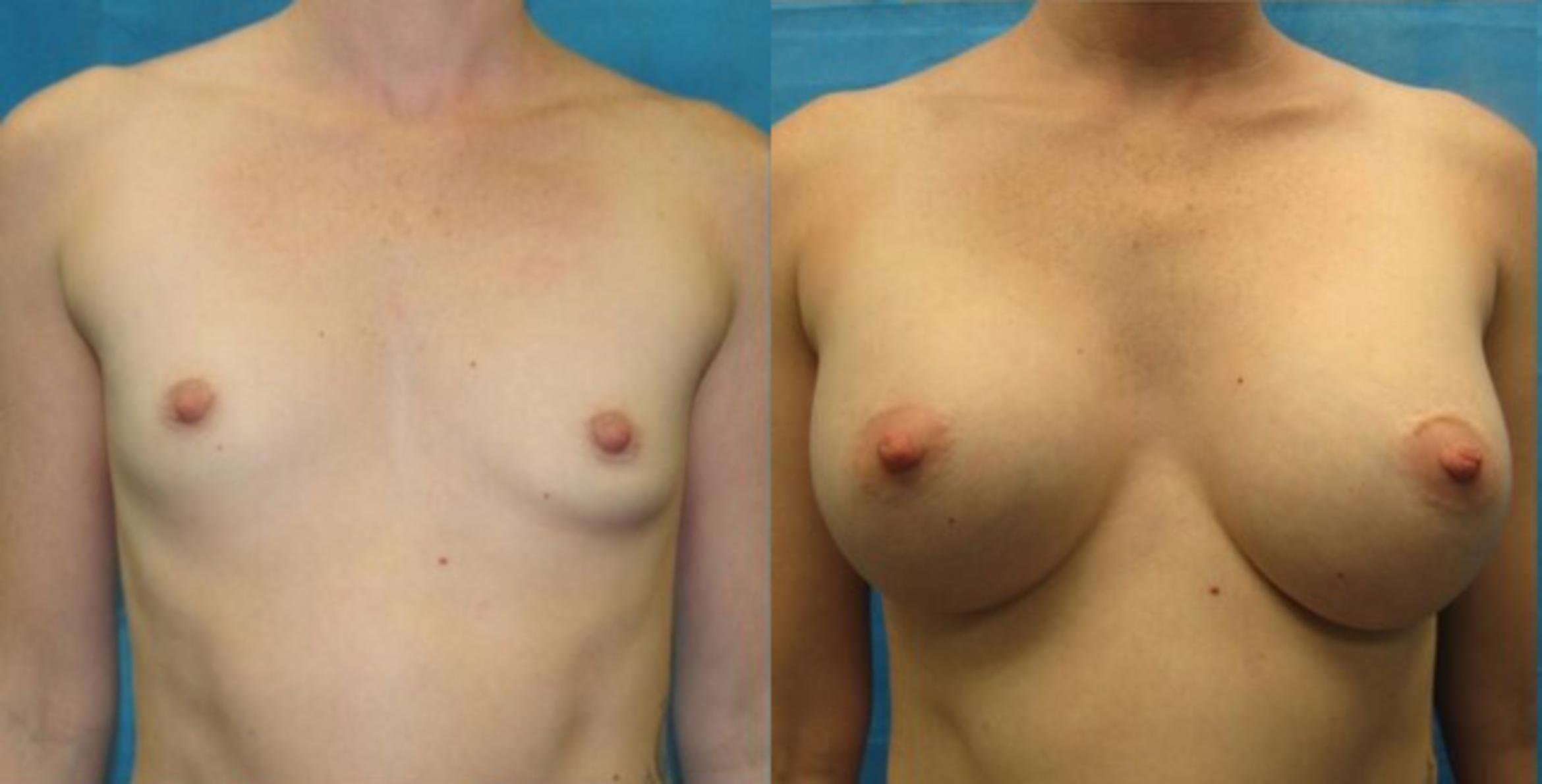 Before & After Breast Augmentation Case 13 View 1 View in Savannah, GA