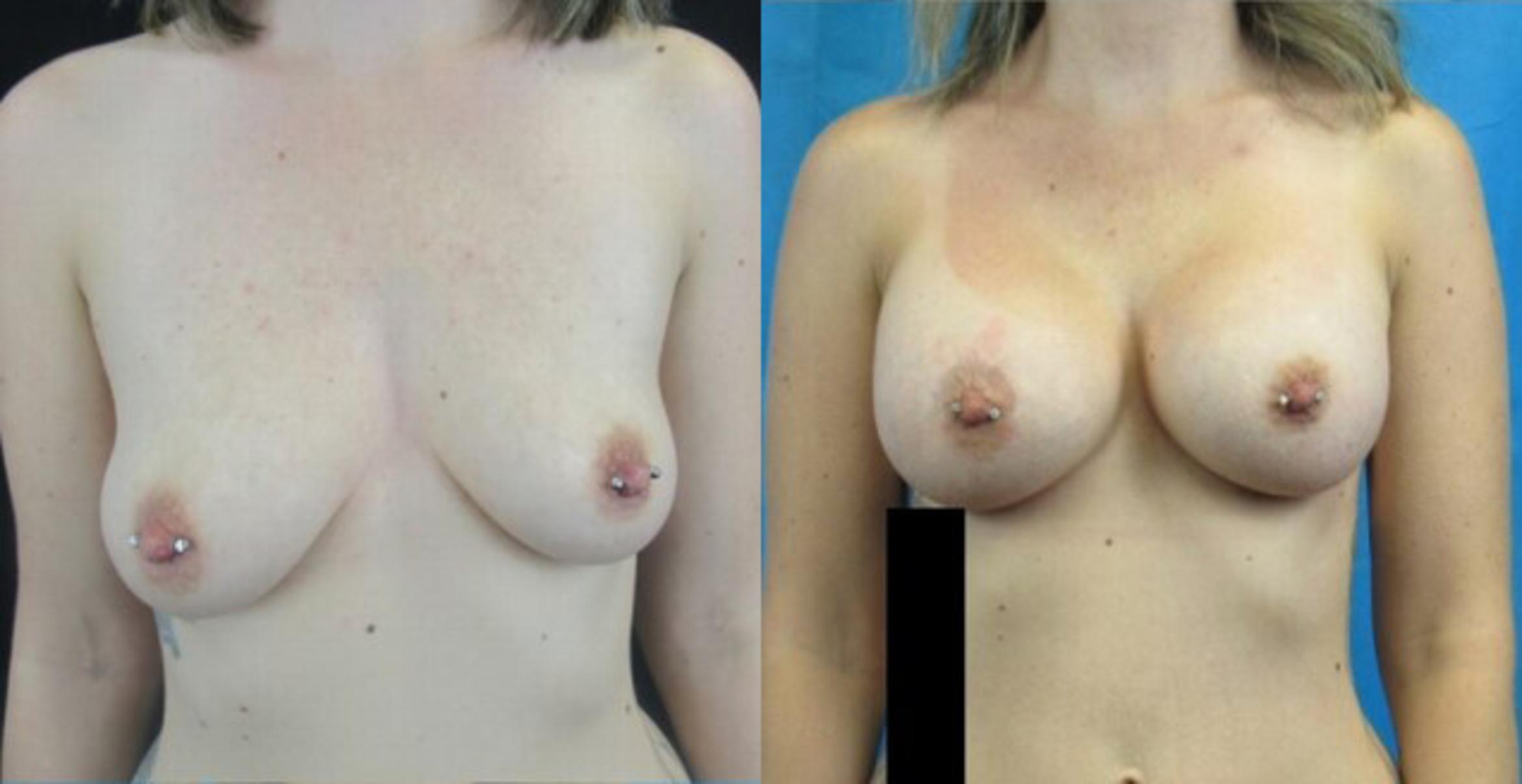Before & After Breast Augmentation Case 14 View 1 View in Savannah, GA