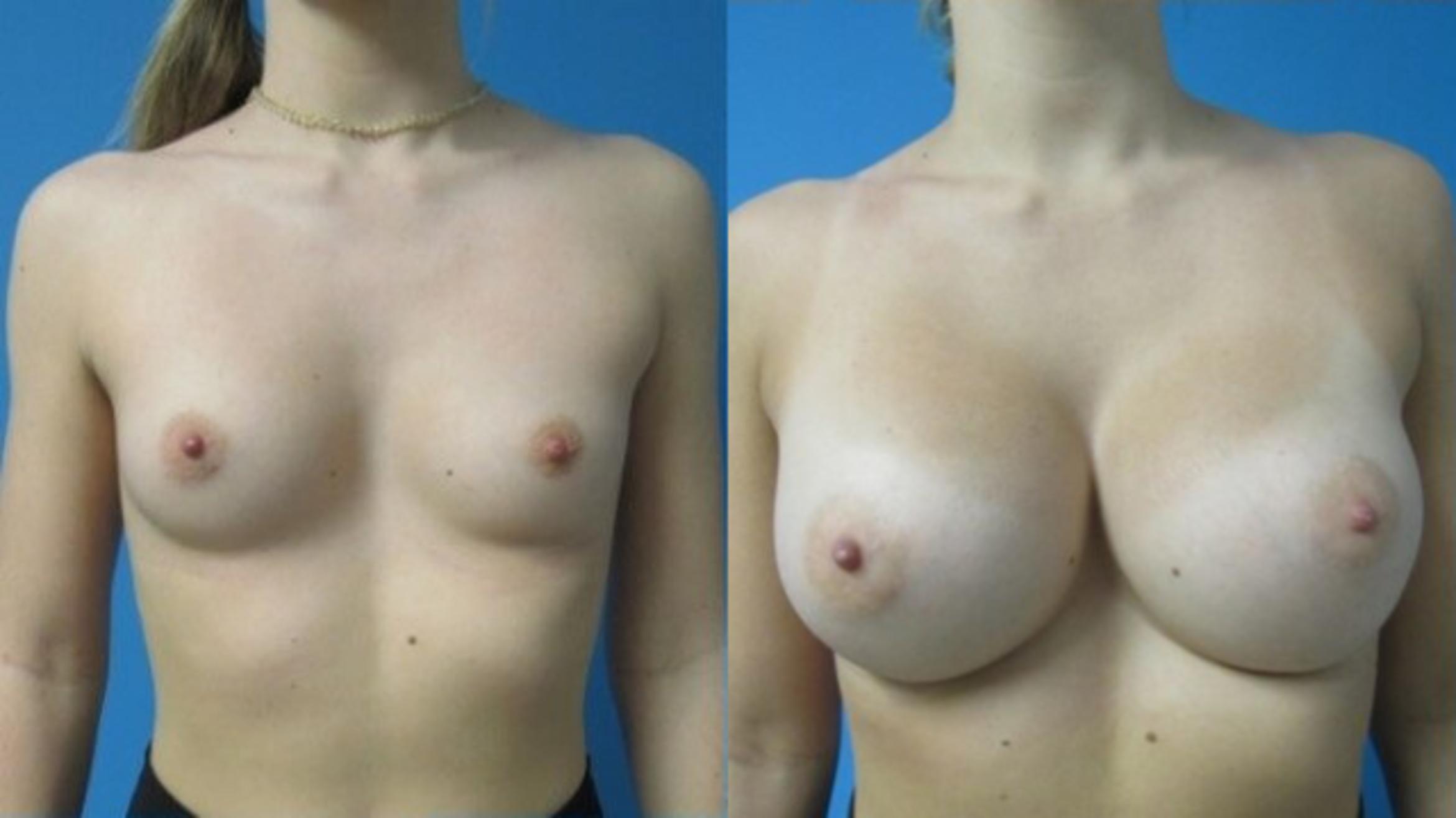 Before & After Breast Augmentation Case 15 View 1 View in Savannah, GA