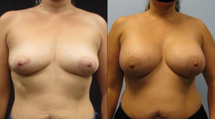 Before & After Breast Augmentation Case 17 View 1 View in Savannah, GA