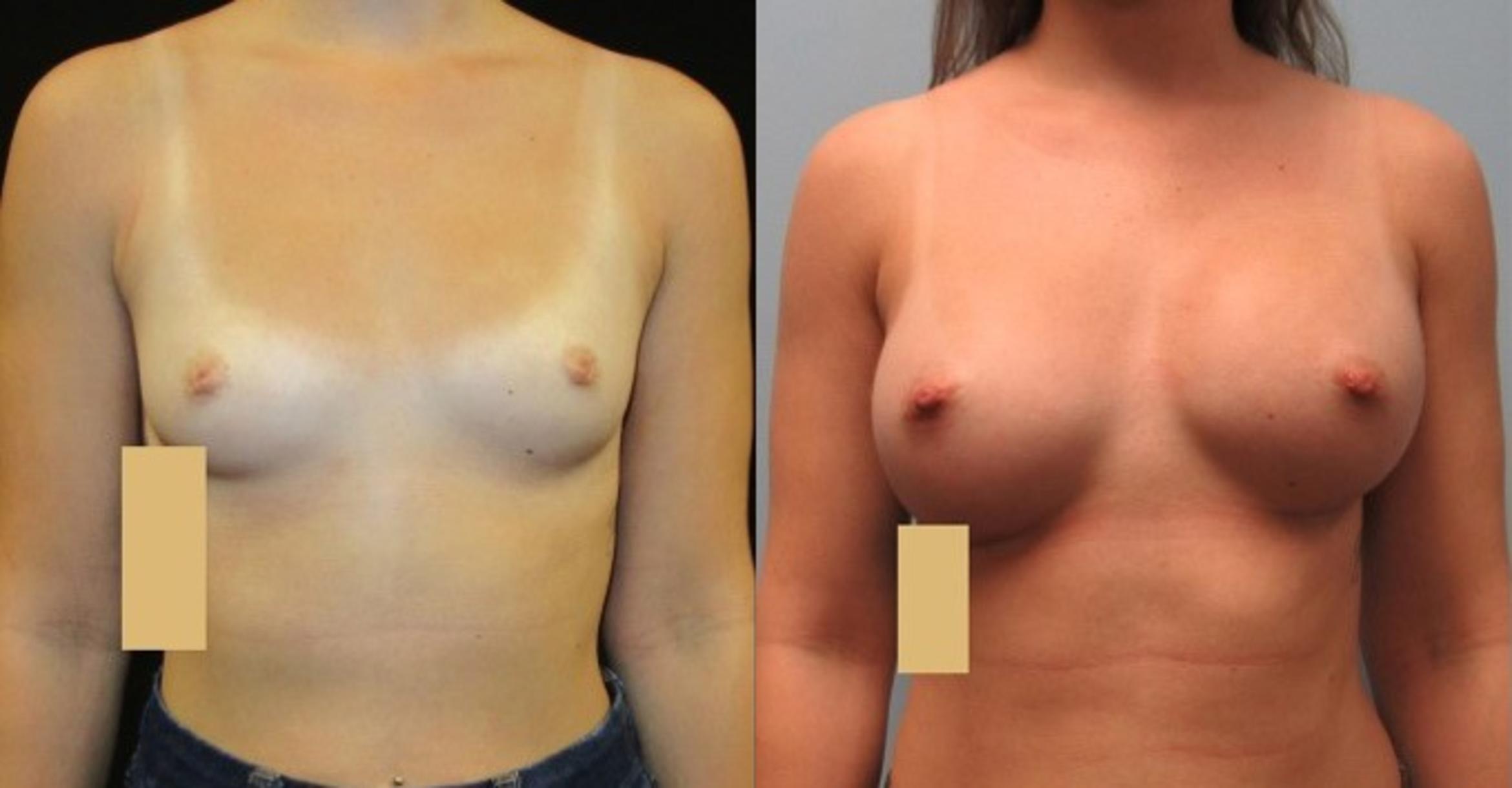 Before & After Breast Augmentation Case 18 View 1 View in Savannah, GA