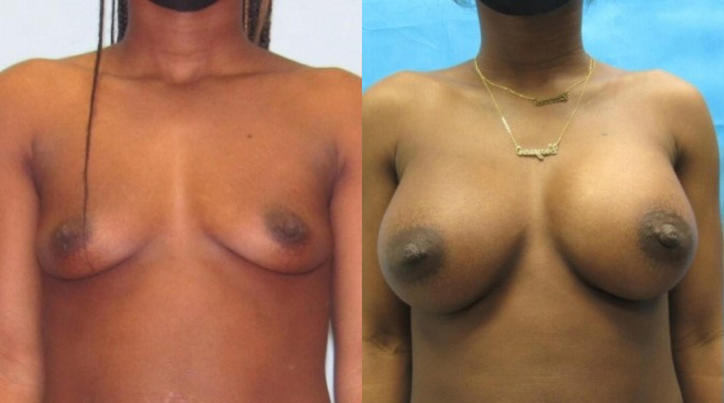 Before & After Breast Augmentation Case 19 View 1 View in Savannah, GA