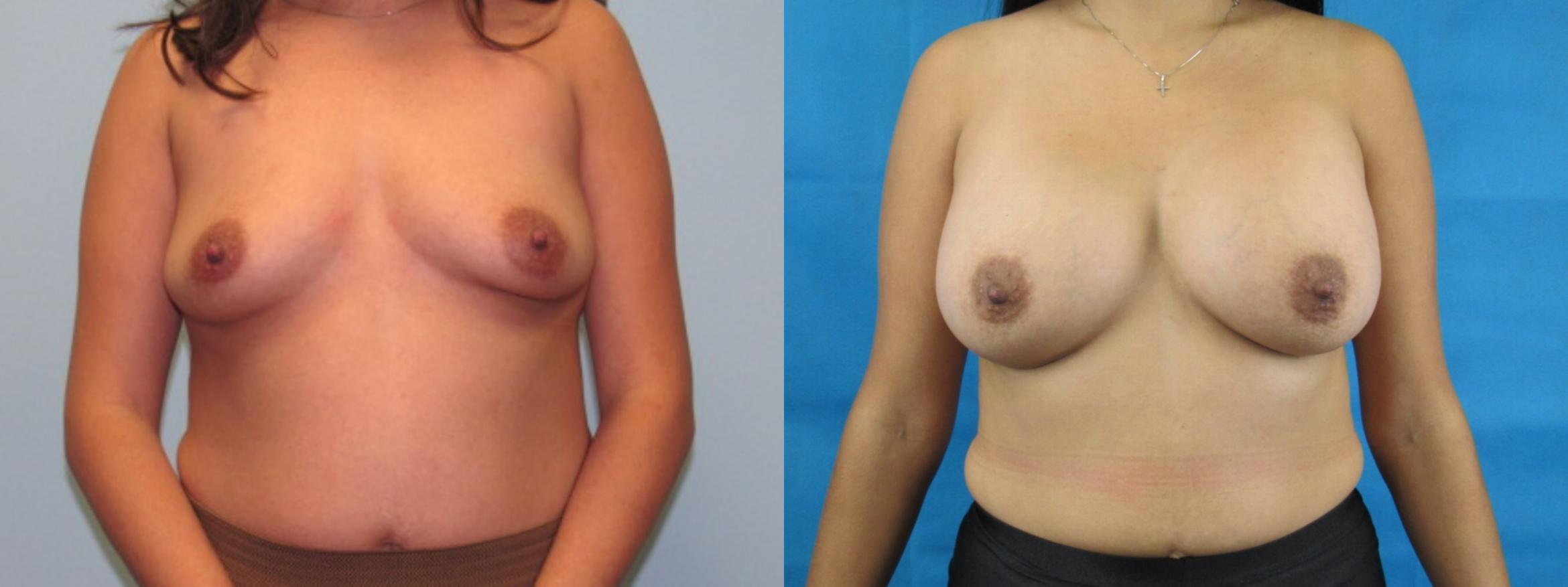 Before & After Breast Augmentation Case 2 View 1 View in Savannah, GA