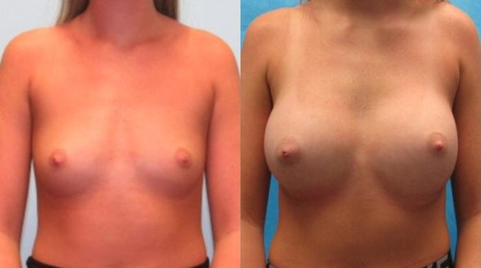 Before & After Breast Augmentation Case 20 View 1 View in Savannah, GA