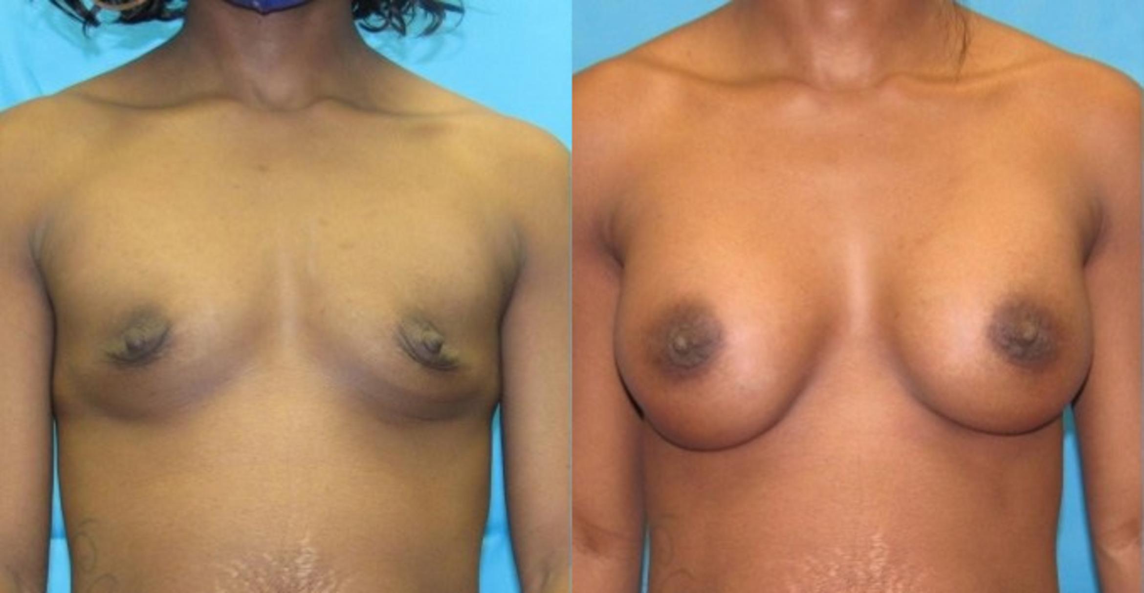 Before & After Breast Augmentation Case 21 View 1 View in Savannah, GA