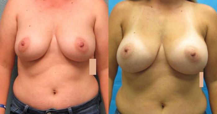 Before & After Breast Augmentation Case 22 View 1 View in Savannah, GA