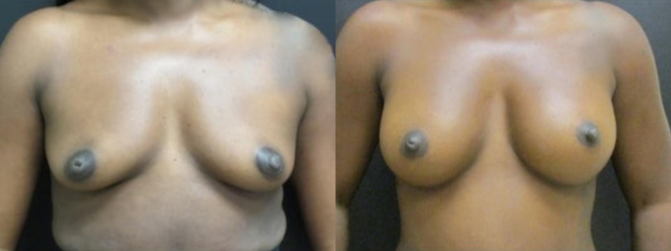 Before & After Breast Augmentation Case 23 View 1 View in Savannah, GA