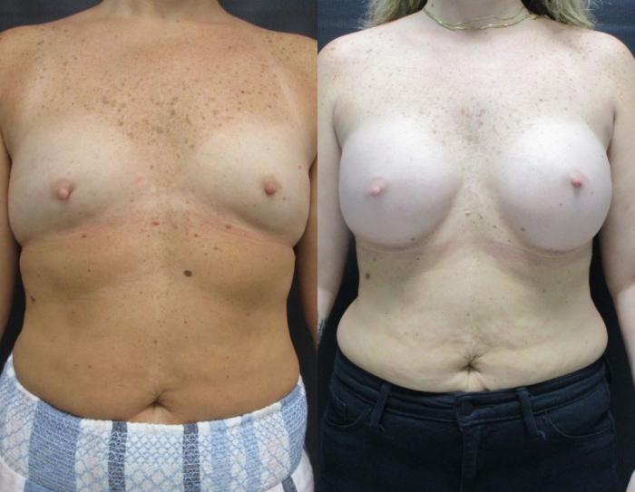 Before & After Breast Augmentation Case 24 View 1 View in Savannah, GA