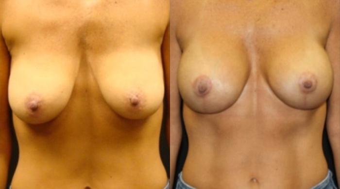 Before & After Breast Augmentation Case 25 View 1 View in Savannah, GA