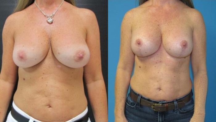 Before & After Breast Augmentation Case 28 View 1 View in Savannah, GA
