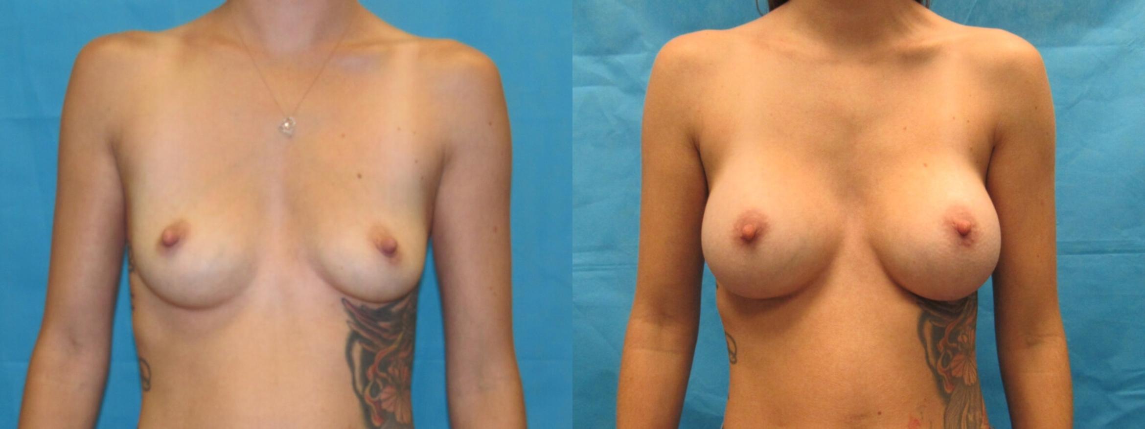 Before & After Breast Augmentation Case 3 View 1 View in Savannah, GA