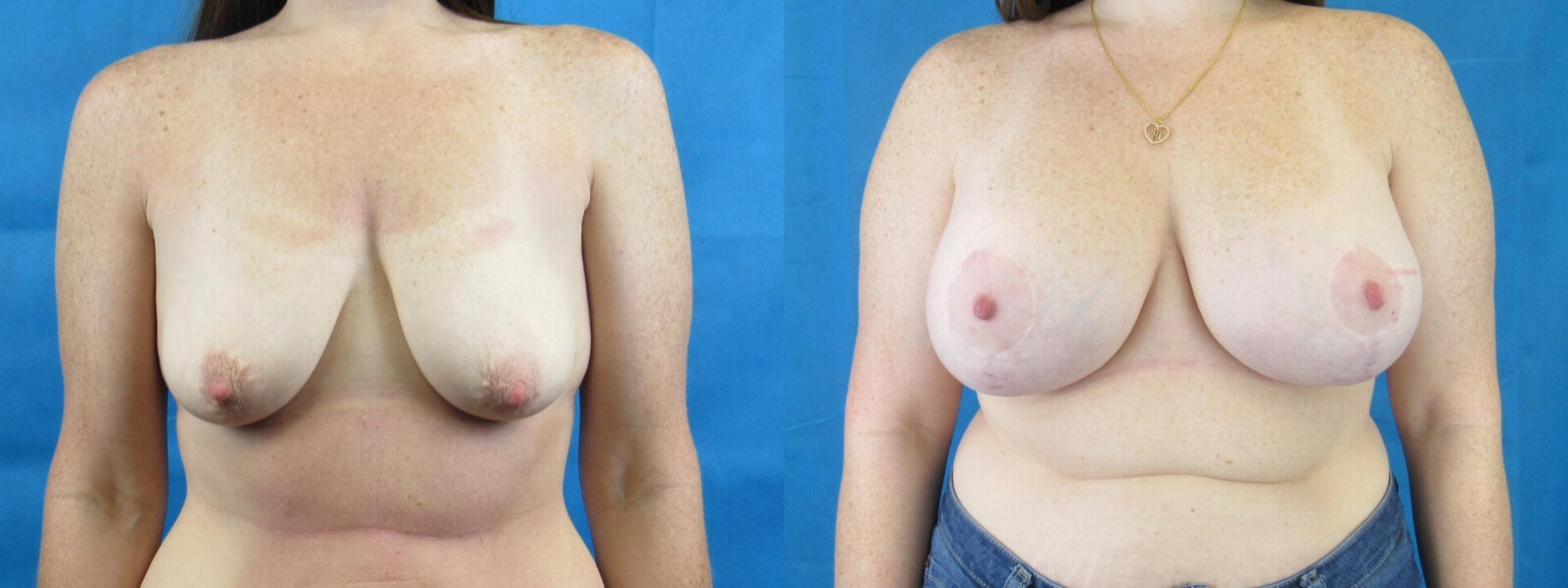 Before & After Breast Augmentation Case 5 View 1 View in Savannah, GA