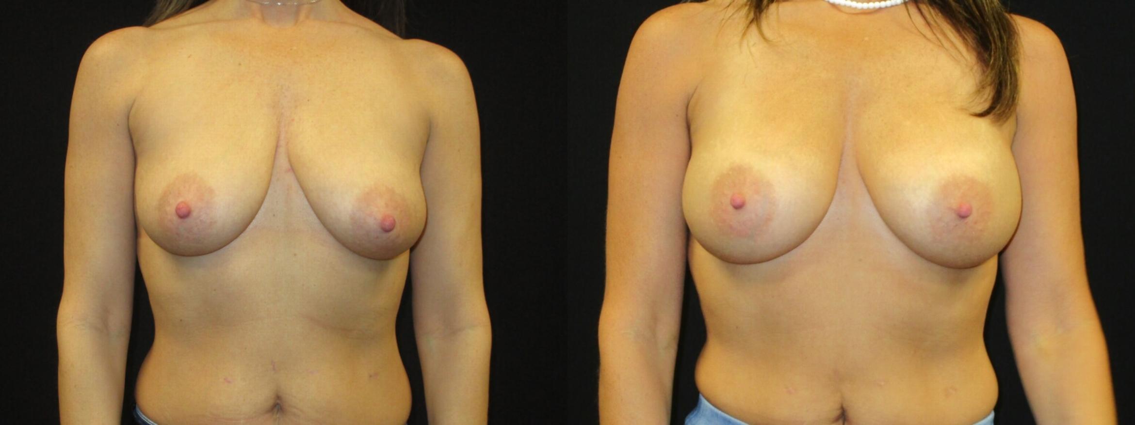 Before & After Breast Augmentation Case 7 View 1 View in Savannah, GA