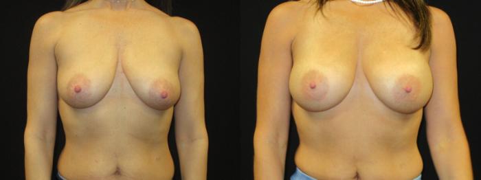Before & After Breast Augmentation Case 7 View 1 View in Savannah, GA