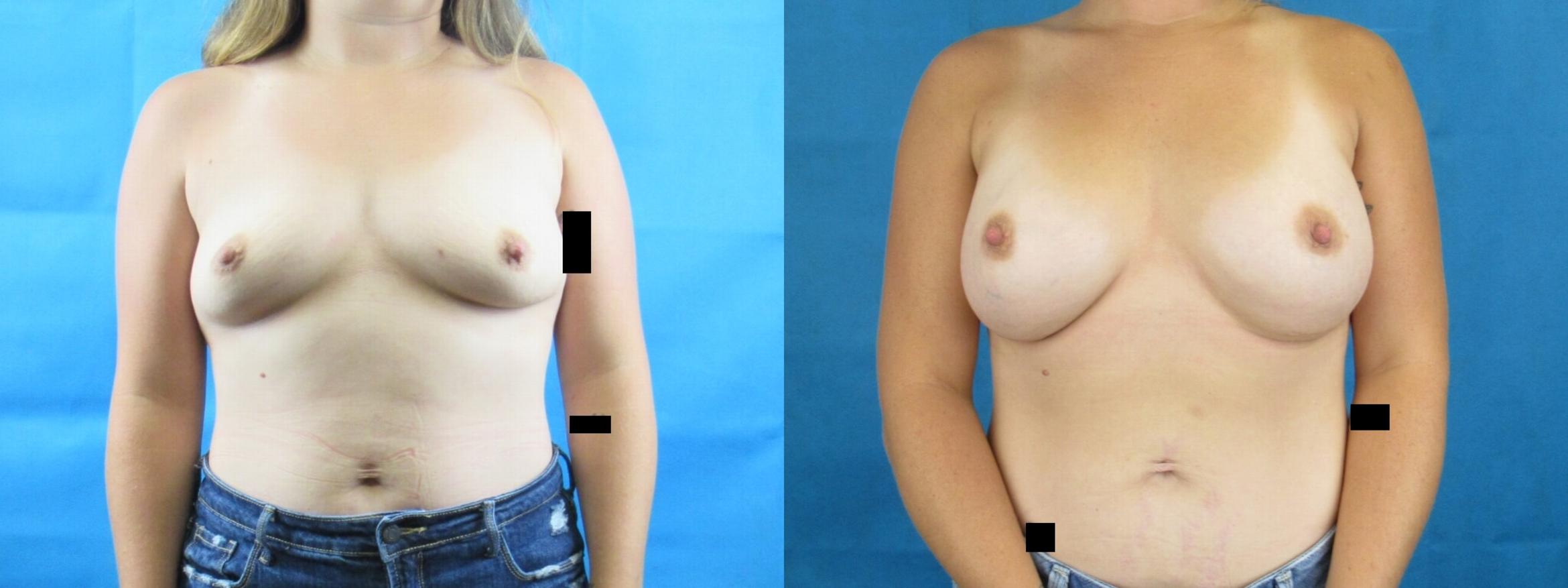 Before & After Breast Augmentation Case 8 View 1 View in Savannah, GA
