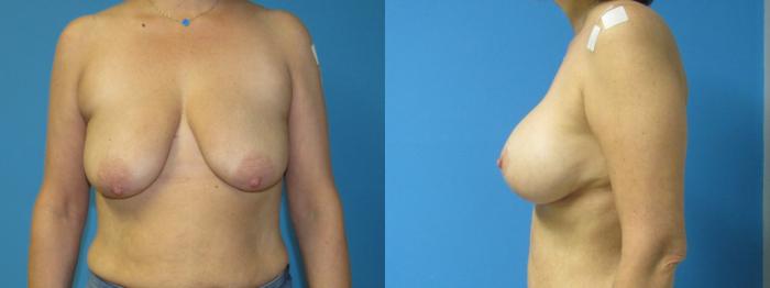 Before & After Breast Lift Case 29 View 1 View in Savannah, GA