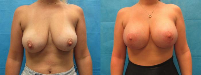 Before & After Breast Lift Case 30 View 1 View in Savannah, GA
