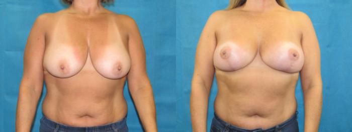 Before & After Breast Lift Case 34 View 1 View in Savannah, GA