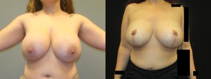 Before & After Breast Lift Case 35 View 1 View in Savannah, GA