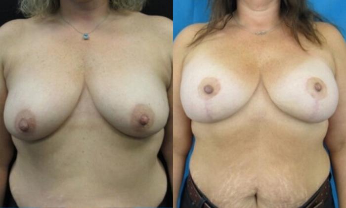 Before & After Breast Lift Case 41 View 1 View in Savannah, GA