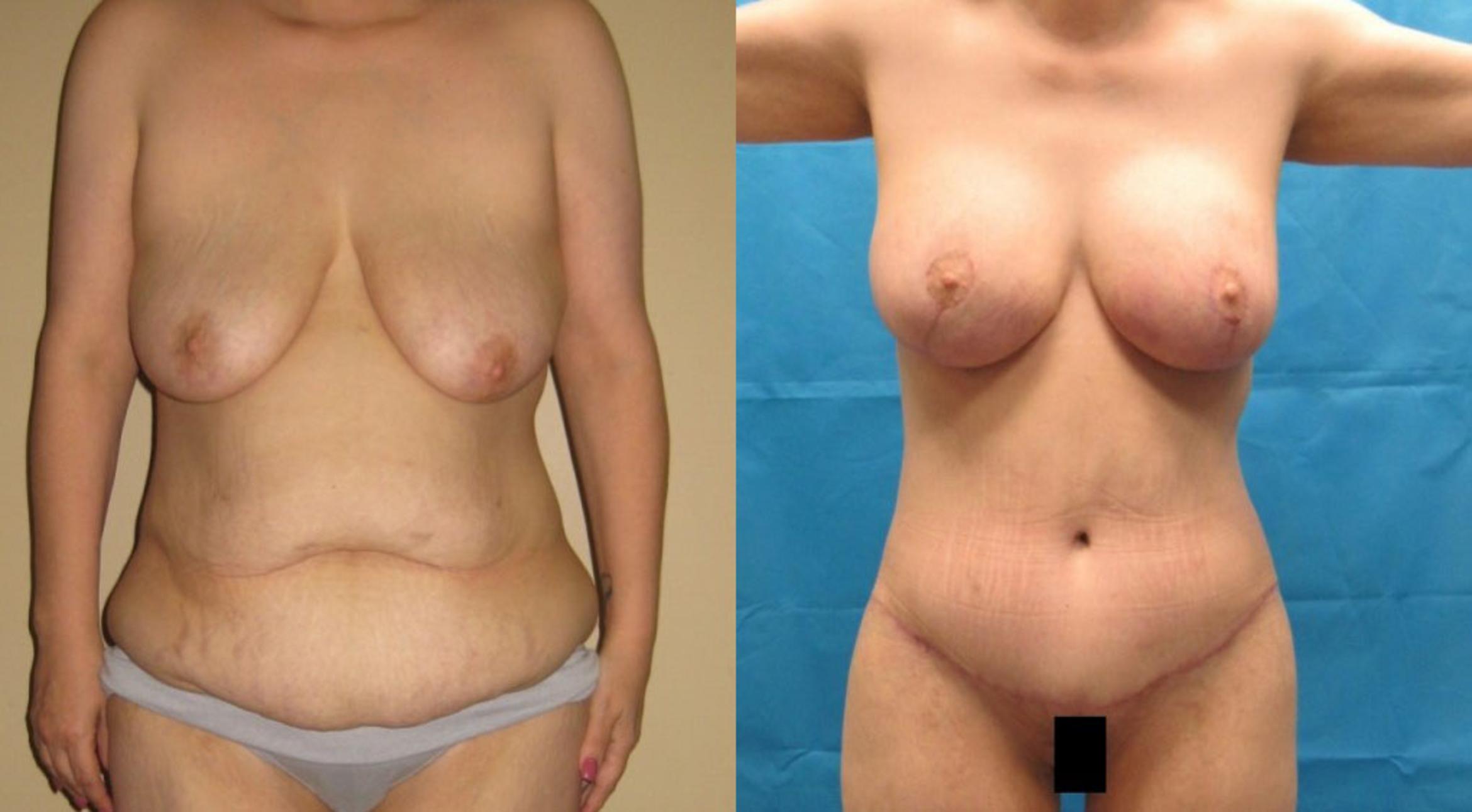 Before & After Breast Lift Case 44 View 1 View in Savannah, GA
