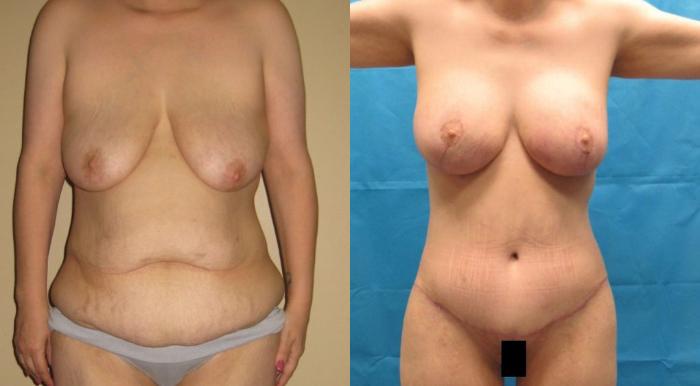 Before & After Breast Lift Case 44 View 1 View in Savannah, GA