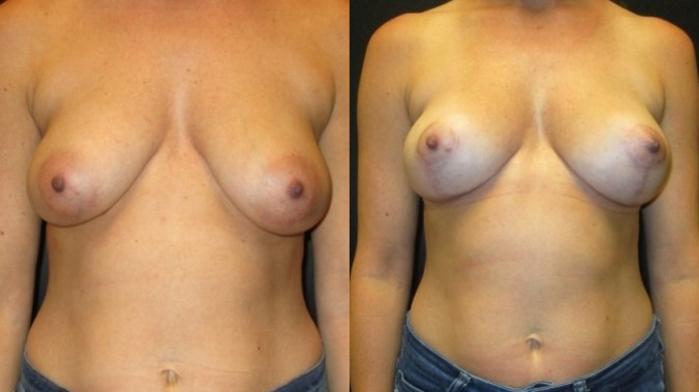 Before & After Breast Lift Case 45 View 1 View in Savannah, GA