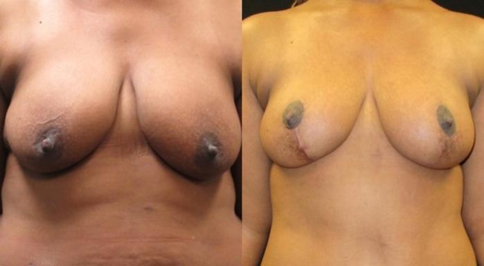 Before & After Breast Lift Case 47 View 1 View in Savannah, GA