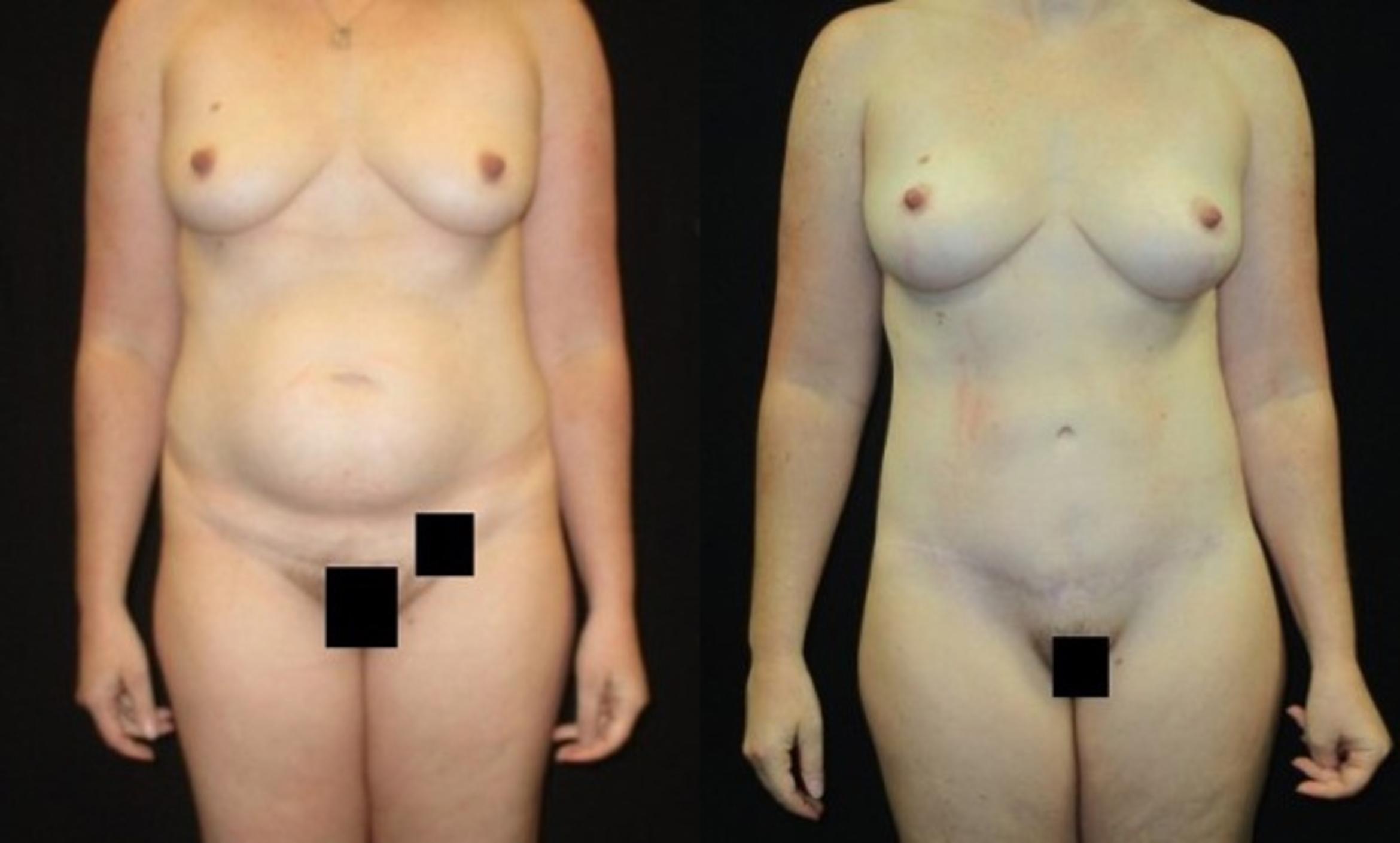 Before & After Breast Lift Case 48 View 1 View in Savannah, GA