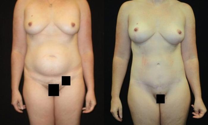 Before & After Breast Lift Case 48 View 1 View in Savannah, GA