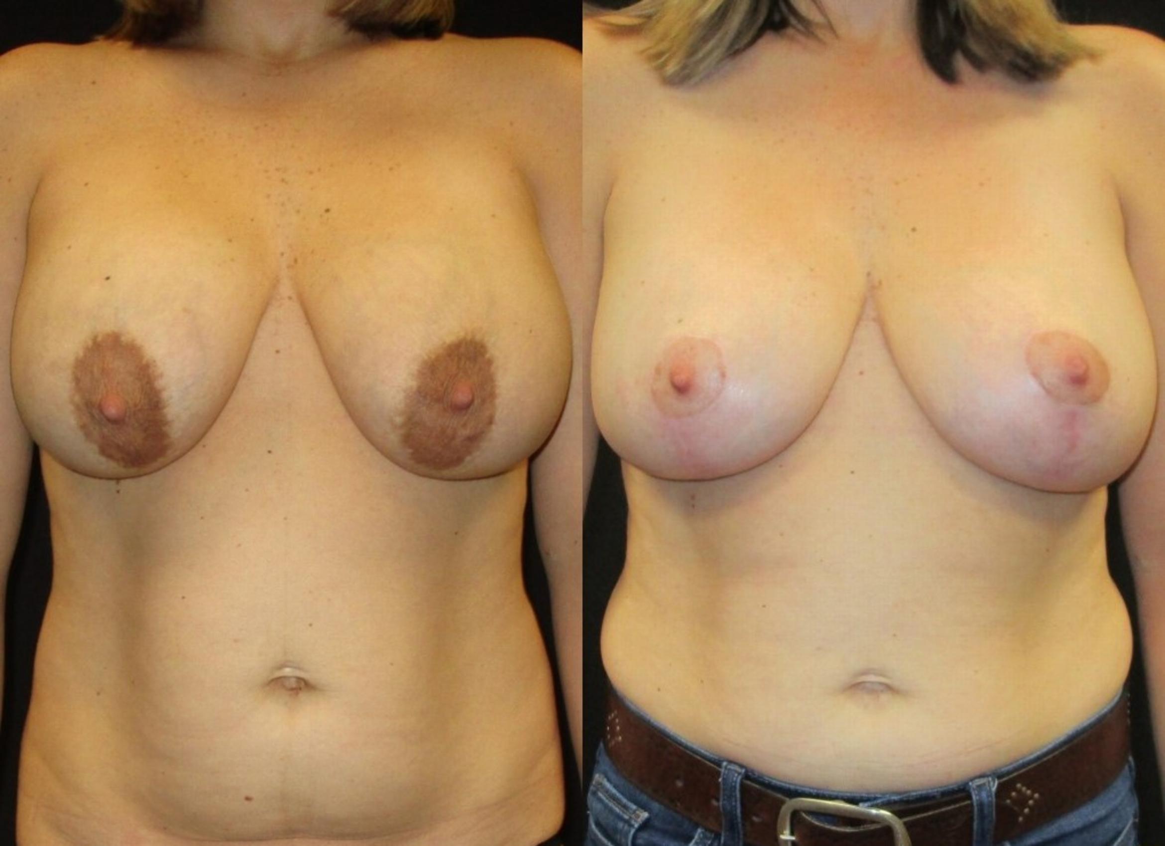 Before & After Breast Lift Case 49 View 1 View in Savannah, GA
