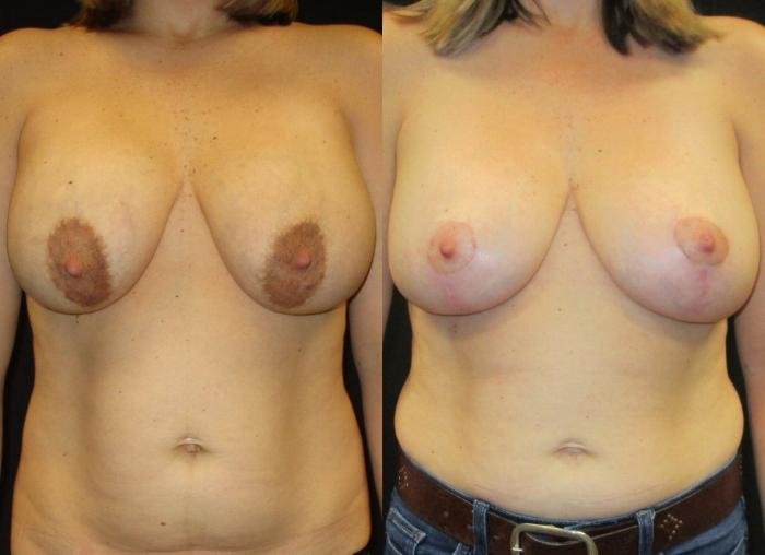 Before & After Breast Lift Case 49 View 1 View in Savannah, GA