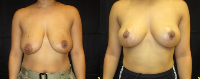 Before & After Breast Lift Case 50 View 1 View in Savannah, GA