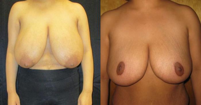 Before & After Breast Reduction Case 51 View 1 View in Savannah, GA