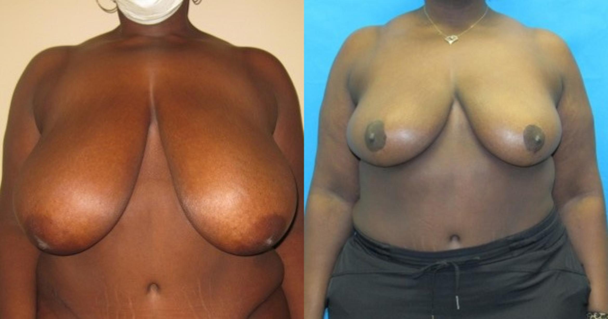 Before & After Breast Reduction Case 52 View 1 View in Savannah, GA