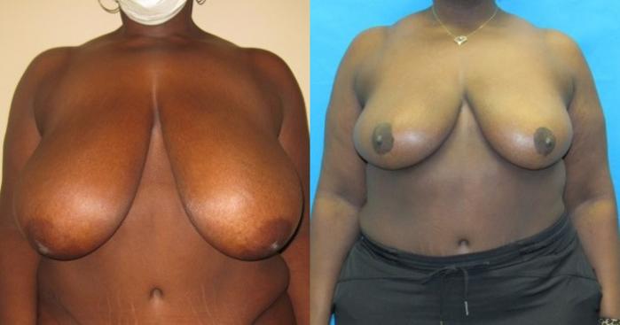 Before & After Breast Reduction Case 52 View 1 View in Savannah, GA