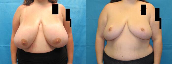 Before & After Breast Reduction Case 53 View 1 View in Savannah, GA