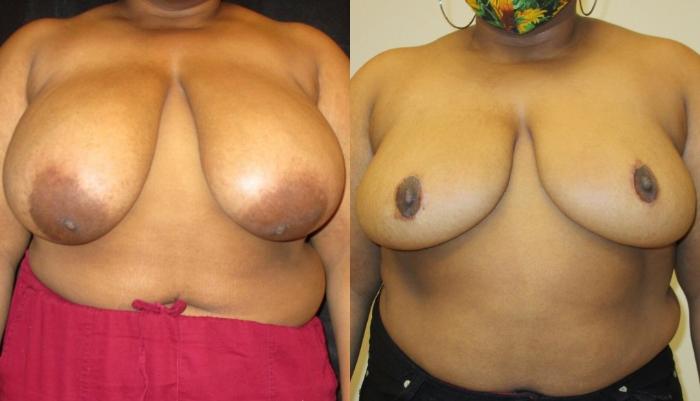Before & After Breast Reduction Case 55 View 1 View in Savannah, GA