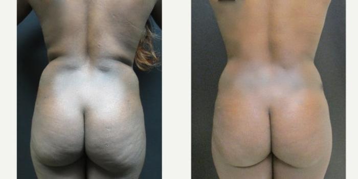 Before & After Liposuction Case 147 View 1 View in Savannah, GA
