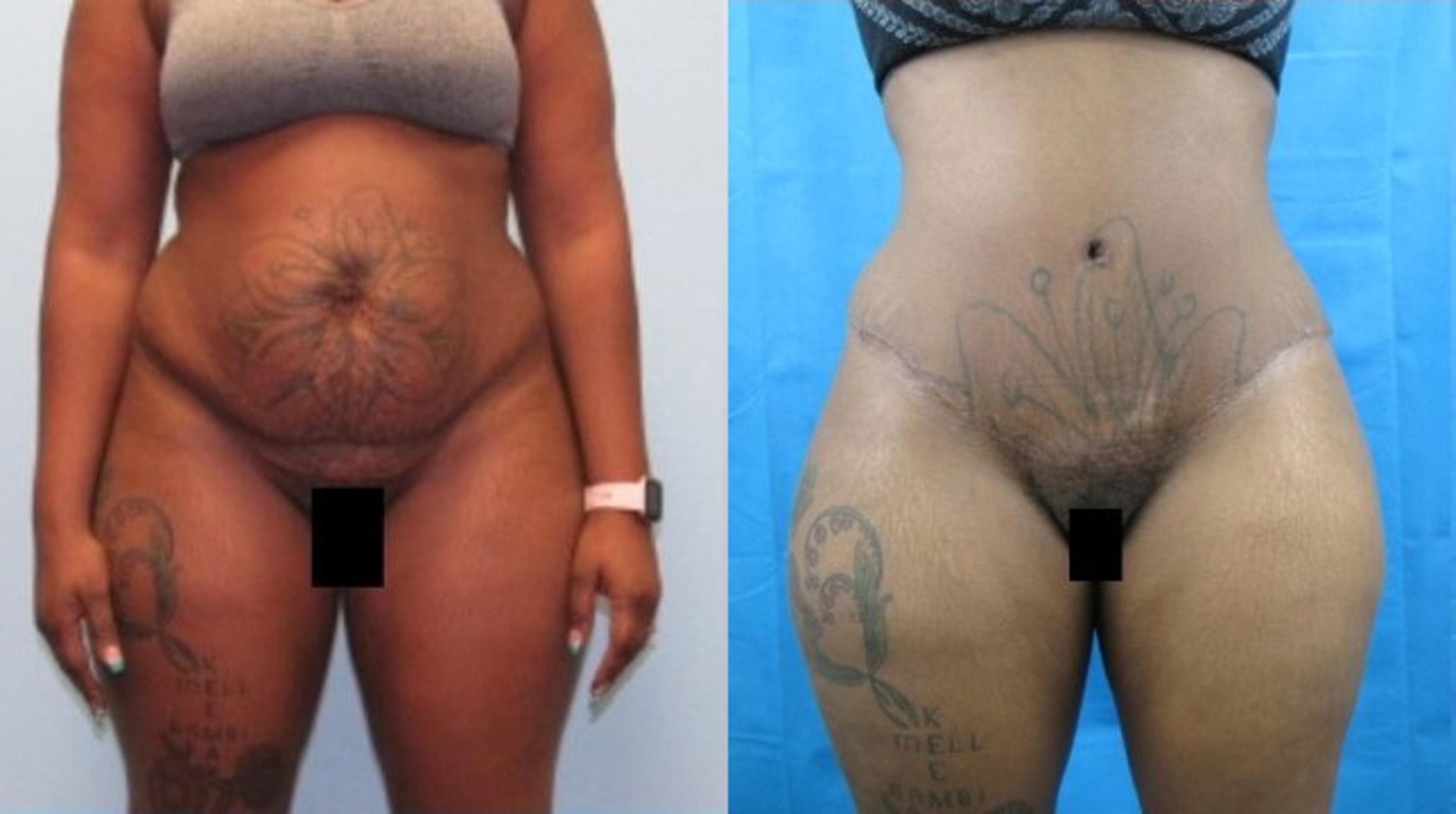 Before & After Liposuction Case 149 View 1 View in Savannah, GA