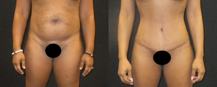 Before & After Liposuction Case 153 View 1 View in Savannah, GA