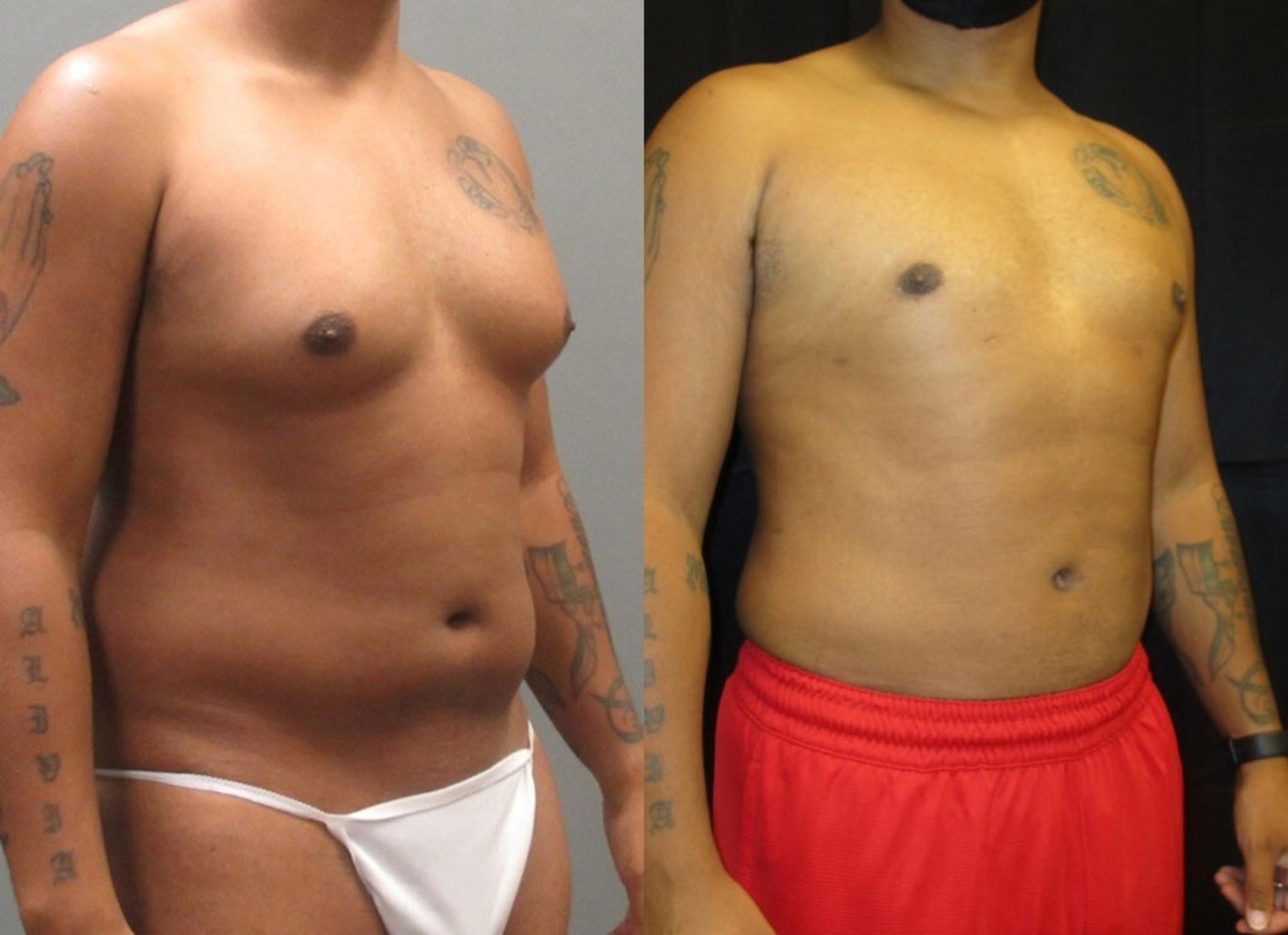 Before & After Liposuction Case 154 View 1 View in Savannah, GA