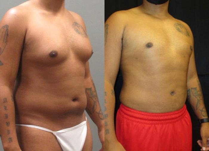 Before & After Liposuction Case 154 View 1 View in Savannah, GA
