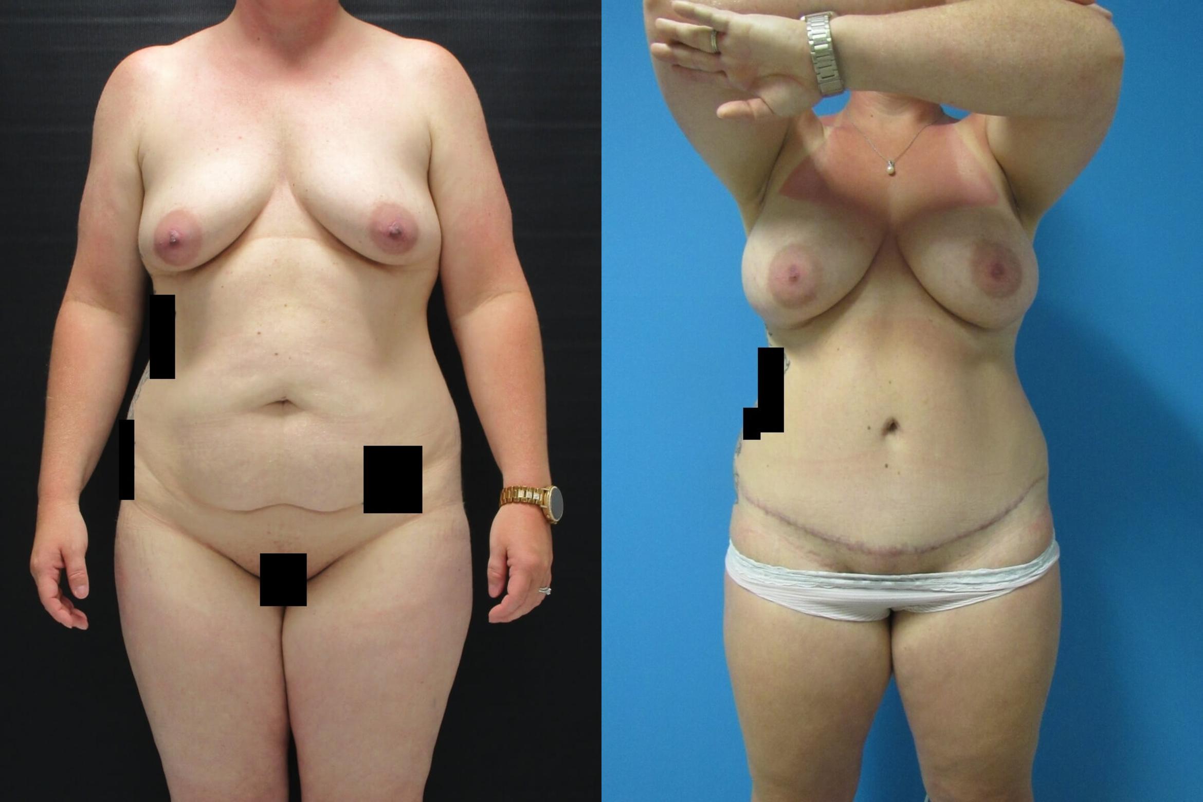 Before & After Mommy Makeover Case 102 View 1 View in Savannah, GA