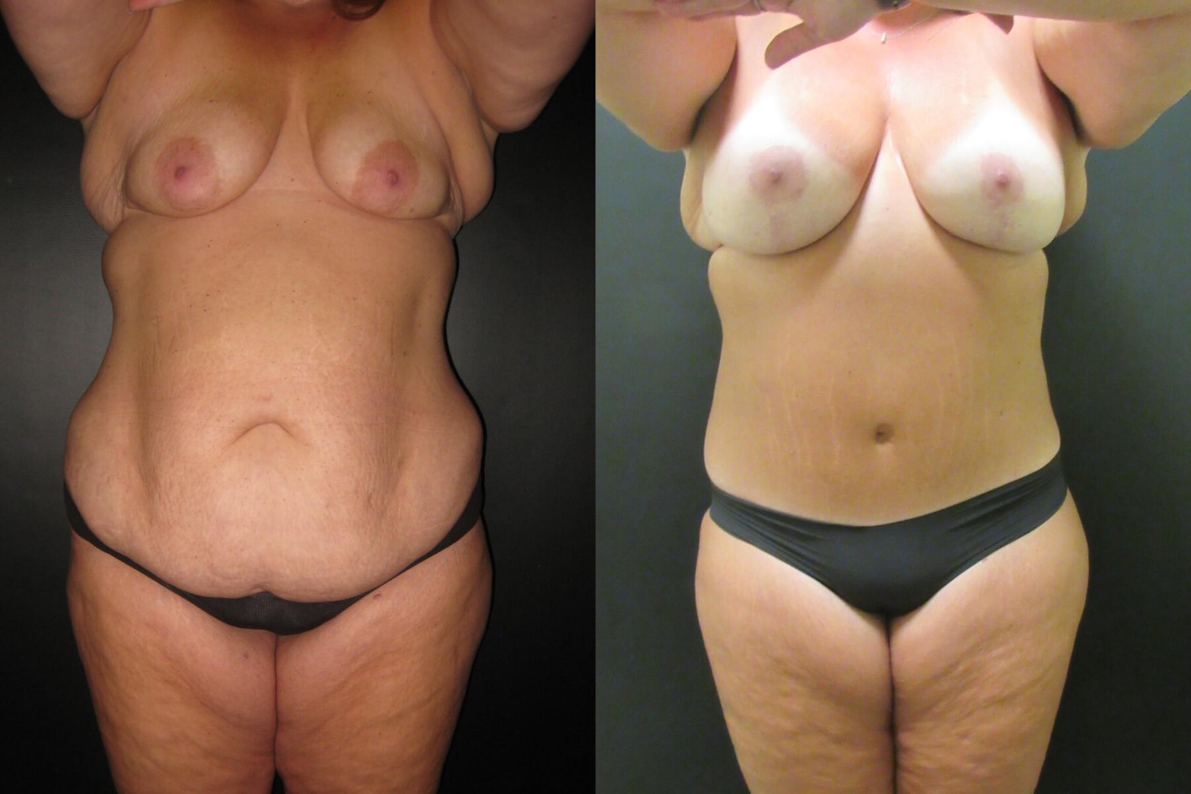 Before & After Mommy Makeover Case 62 View 1 View in Savannah, GA