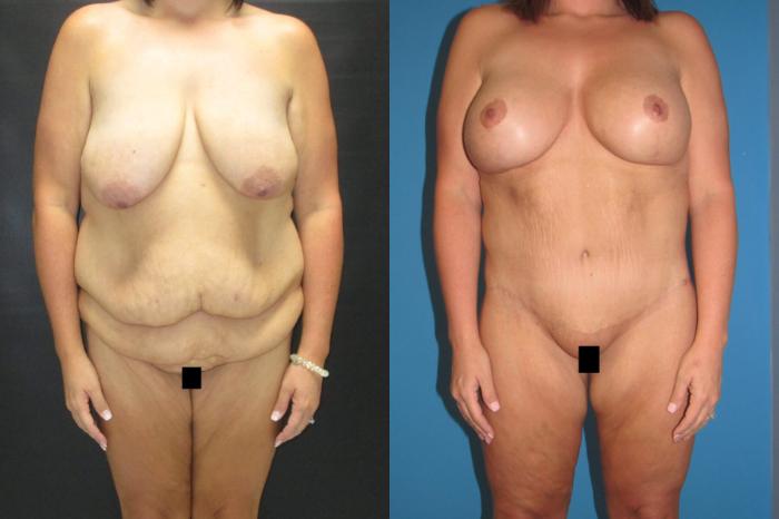 Before & After Mommy Makeover Case 68 View 1 View in Savannah, GA