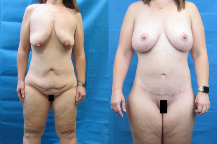 Before & After Mommy Makeover Case 73 View 1 View in Savannah, GA
