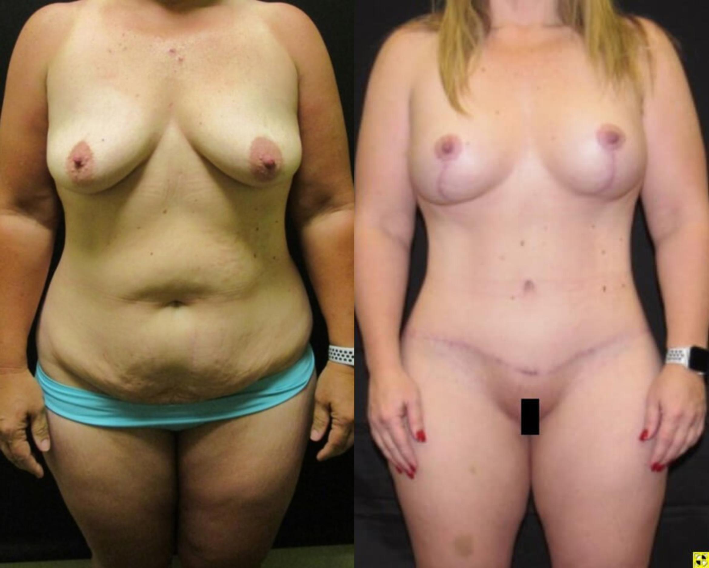 Before & After Mommy Makeover Case 79 View 1 View in Savannah, GA